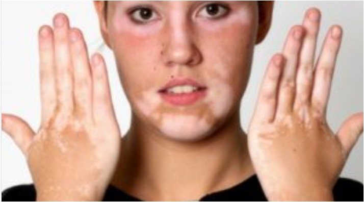 Vitiligo- white patches
