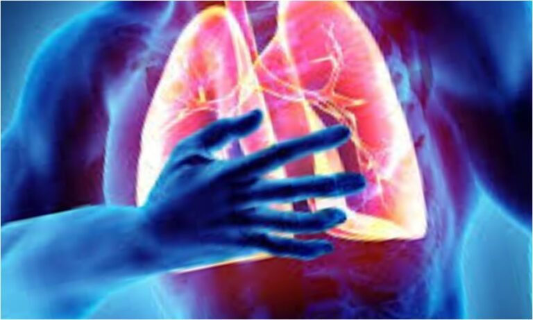 pulmonary fibrosis- Lungs