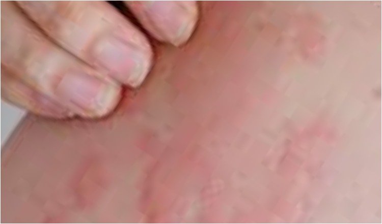 Health Tips- urticaria- skin allergy - prickly bumps on skin